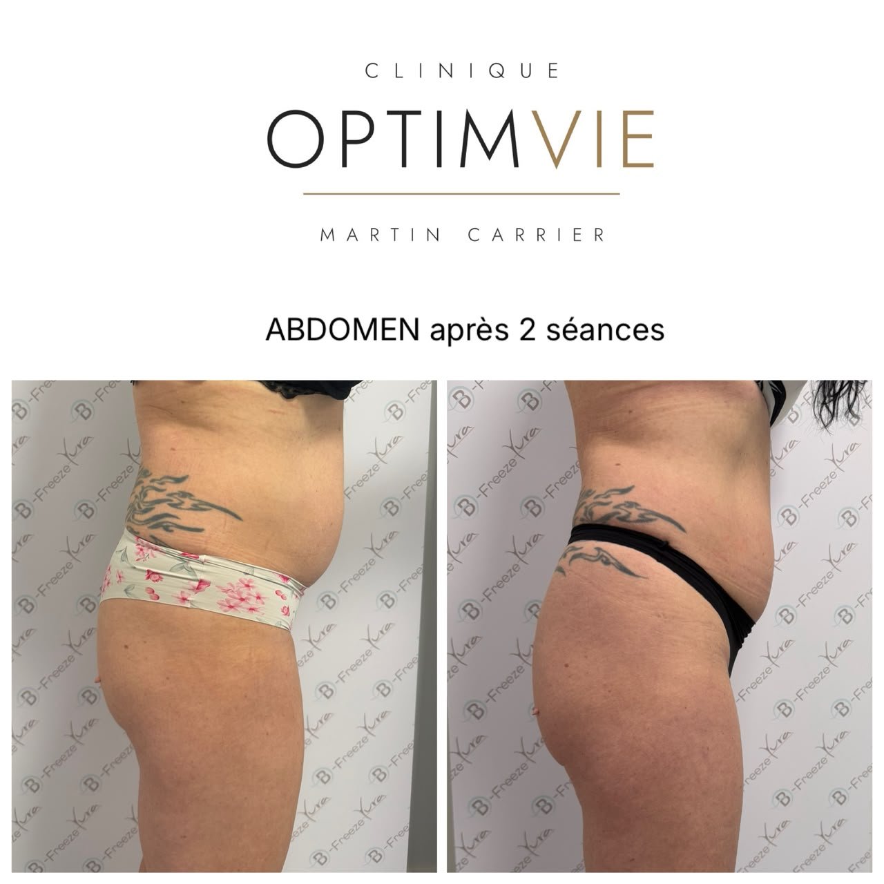 Avant/après B-Freeze — abdomen après 2 séances