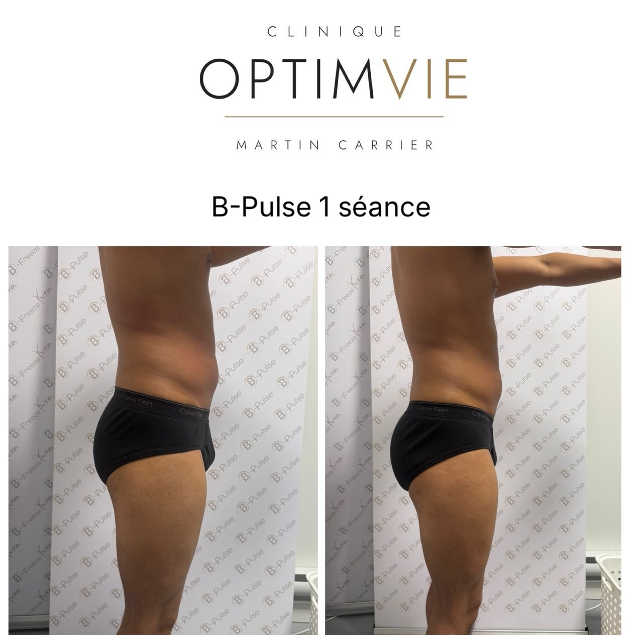 Avant/après B-Pulse — abdomen après 1 séance